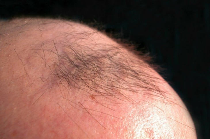 Лечение выпадения волос: назван препятствующий облысению напиток