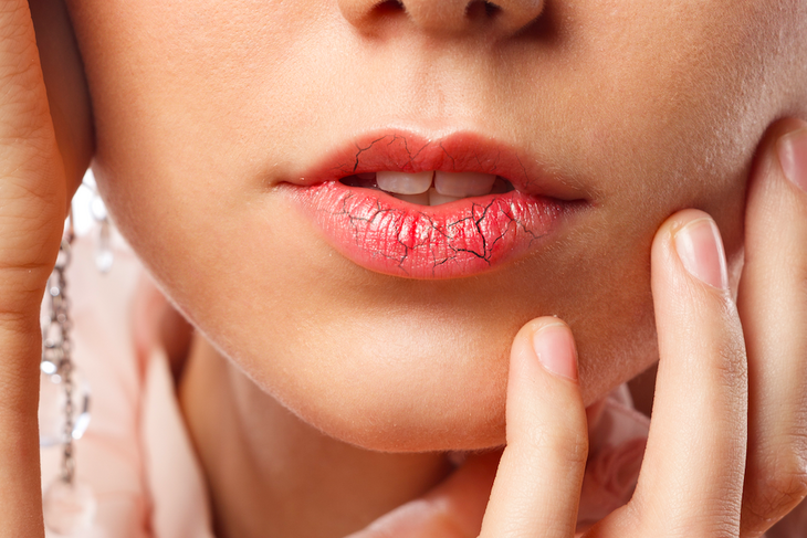 Как за один день восстановить обветренные губы