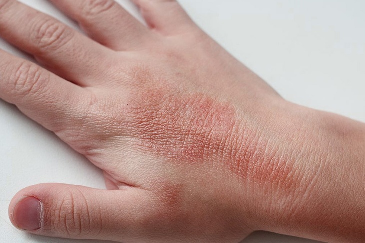 Мучительная инфекция: названо жуткое хроническое поражение кожи, возникающее из-за стресса