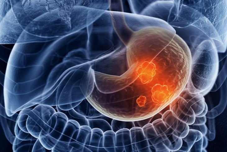Угроза мучительной смерти: описаны неожиданные симптомы рака желудка 