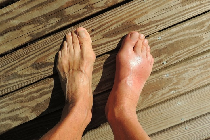 Синюшные пальцы на ногах: медики перечислили симптомы омикрона, появляющиеся на коже