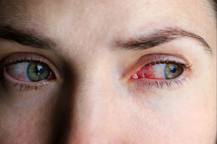 Грозит страшная смерть: назван необычный симптом в глазу, говорящий о редкой форме рака