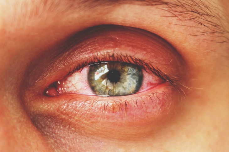 Много-много кровоизлияний: названы глазные симптомы, по которым можно определить диабет