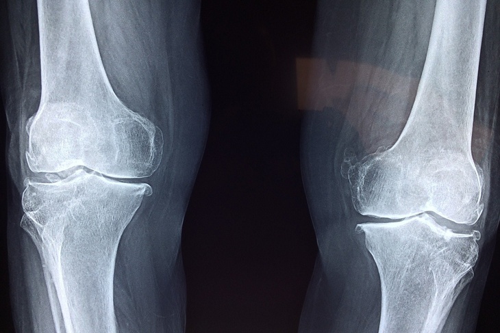Россиянам назвали эффективные способы справиться с болью в коленях