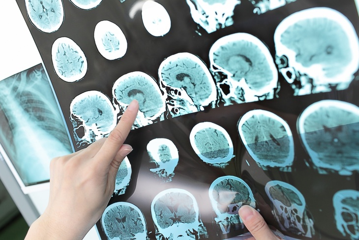Простой тест поможет вовремя выявить смертельно опасную опухоль мозга: проверьте свое здоровье